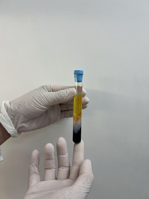 CFM regulamenta PRP em condições osteomusculares